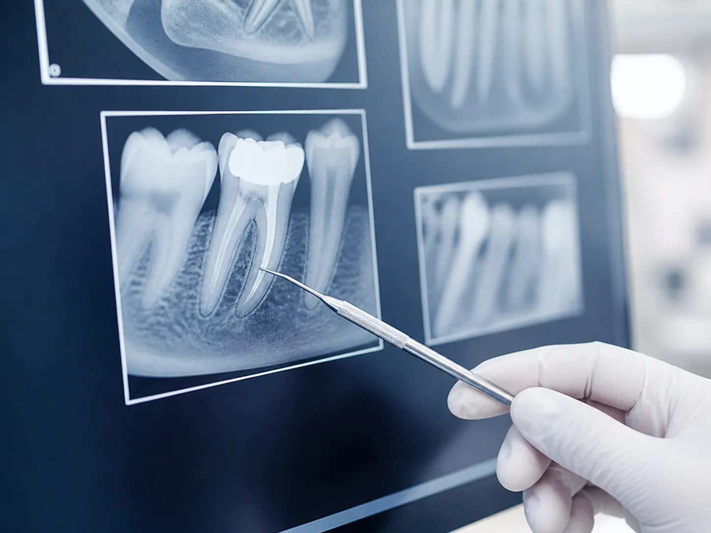 Rayos X Dental procedimiento